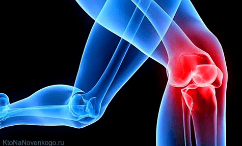 Arthrose
