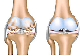 Articulations saines et arthrose