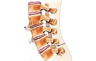 Spondylarthrose comme causes de maux de dos
