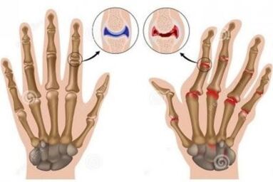 Les causes de la douleur dans les articulations des doigts