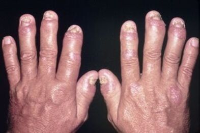 Pourquoi blesser les articulations des doigts
