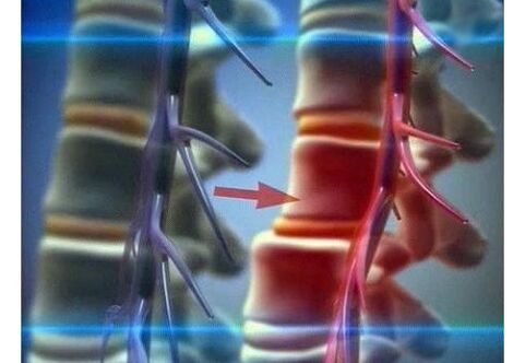 Compression des terminaisons nerveuses dans l'ostéochondrose lombaire