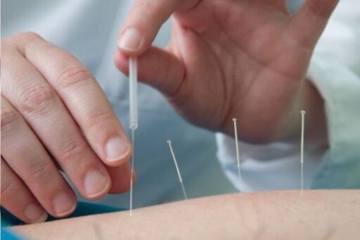 L'acupuncture est une méthode de traitement des douleurs lombaires causées par l'ostéochondrose
