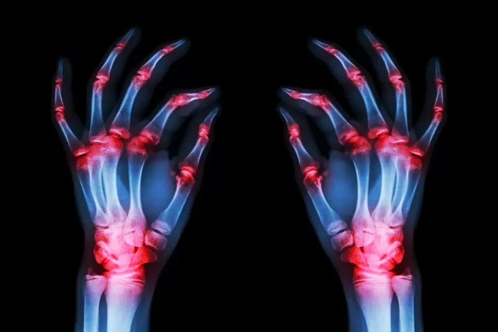 Arthrose des articulations des doigts