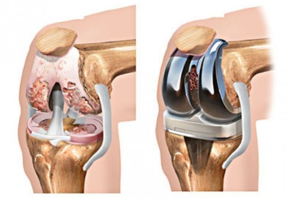 Prothèse du genou dans l'arthrose