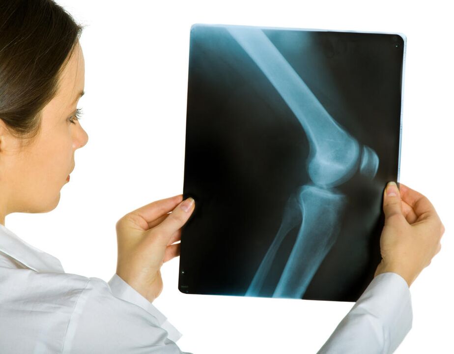 Une radiographie de l'articulation du genou montre la présence d'arthrose déformante